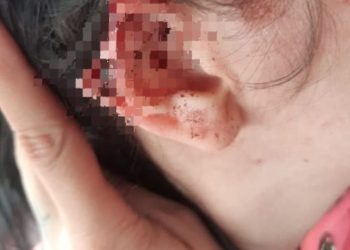 Jovem é preso após arrancar parte da orelha da namorada com mordida