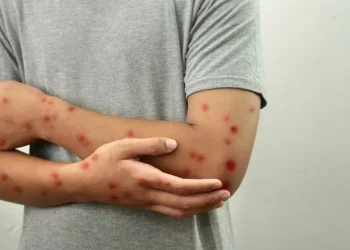 Saúde confirma primeiro caso de nova cepa de mpox no Brasil