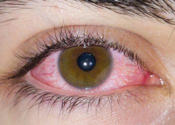 Nova Variante XFG da Covid-19 é Detectada no Brasil, Mas OMS Avalia Risco Global Como Baixo