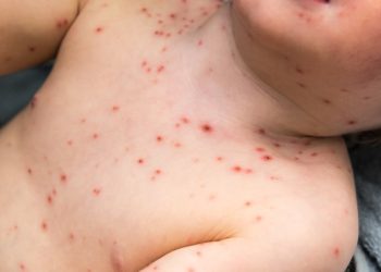 Saúde está em alerta máximo por aumento do sarampo nas Américas