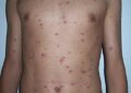 Altamente contagiosa, a catapora voltou a chamar a atenção no Espírito Santo após a Prefeitura de Guarapari emitir um alerta sobre o aumento de casos da doença. Desde a segunda quinzena de maio até a última sexta-feira (7), a Secretaria Municipal de Saúde (Semsa) contabilizou 18 notificações, sendo 16 casos confirmados e dois descartados. O número representa uma alta expressiva, já que, de janeiro a agosto do ano passado, o município havia notificado apenas dois casos não confirmados. Diante desse cenário, a Vigilância Epidemiológica tem realizado monitoramento e investigação dos registros, além de orientar as equipes de saúde sobre as medidas de prevenção e controle. “É importante que a população fique atenta aos sintomas e procure uma unidade de saúde assim que houver suspeita” Em Vila Velha, foram notificados 17 casos no período entre janeiro e sexta-feira (7), dos quais 10 foram confirmados, segundo a Secretaria Municipal de Saúde. A infectologista da Secretaria de Saúde de Vila Velha, Mylene Murad, afirma que o cenário não é considerado alarmante, mas reforça que a população deve permanecer atenta aos sinais da doença. “Os principais sintomas são febre, mal-estar e as manchinhas espalhadas pelo corpo. É preciso ter cuidado principalmente ao coçar, para não causar infecções ainda mais sérias.” Na Serra, a Secretaria de Saúde informou que, entre janeiro e julho deste ano, foram confirmados 21 casos de catapora. A referência técnica em agravos da Secretaria de Saúde do município, Maria Isabel Delmaestro, diz que o número está dentro do esperado para o período, mas reforça a importância da vacinação. “No Sistema Único de Saúde, a vacina está amplamente disponível. A primeira dose é feita aos 15 meses e a segunda aos quatro anos. Ela reduz muito a chance de evoluir para casos graves.” Em Vitória, foram confirmados 21 casos de catapora entre janeiro e julho deste ano, segundo a Secretaria Municipal de Saúde. A vacina contra a doença está disponível em todas as unidades de saúde do município. Já em Cariacica, até sexta-feira (7), foram notificados 14 casos de catapora neste ano, dos quais 12 foram confirmados, de acordo com a Secretaria Municipal de Saúde. O que é a catapora e como ocorre a transmissão Também conhecida como varicela, a catapora é uma doença infecciosa causada por vírus e altamente contagiosa. A transmissão ocorre pelo ar, por meio de fala, tosse e espirros, e também pelo contato direto com o líquido das lesões ou com objetos contaminados. A pessoa pode transmitir a doença antes mesmo do aparecimento das lesões e continua contagiosa enquanto houver lesões ativas na pele. Sintomas mais comuns da doença Entre os principais sinais e sintomas da catapora estão: Febre Mal-estar Dor de cabeça Manchas vermelhas pelo corpo Bolhas na pele Formação de crostas Coceira intensa Cuidados e quando procurar atendimento Alguns cuidados são essenciais para evitar complicações e novas transmissões: Evitar coçar as lesões, pois elas podem ser contaminadas e provocar infecções secundárias. Pessoas com suspeita ou confirmação da doença devem evitar contato com outras pessoas. Retornar às atividades apenas quando todas as lesões estiverem em fase de crosta. Ao apresentar sintomas, procurar uma unidade de saúde para avaliação. Vacinação contra a catapora pelo SUS A vacina é a principal forma de prevenção contra a catapora. No Sistema Único de Saúde (SUS), a primeira dose é aplicada aos 15 meses de idade, e a segunda dose é aplicada aos quatro anos. Nos municípios citados, a imunização está disponível nas unidades de saúde, e as prefeituras reforçam a importância de manter o calendário de vacinação em dia para reduzir o risco de casos graves. Números de casos de catapora no ES Confira a situação informada pelas prefeituras e secretarias de Saúde: Guarapari: 18 notificações desde a segunda quinzena de maio até 7 de agosto, sendo 16 casos confirmados. Vitória: 21 casos confirmados entre janeiro e julho; no mesmo período de 2025, foram 26 casos. Vila Velha: 17 notificações entre 1º de janeiro e 7 de agosto, sendo 10 casos confirmados. Serra: 21 casos confirmados entre janeiro e julho. Cariacica: 14 notificações até 7 de agosto, com 12 casos confirmados. Veja mais em: https://tribunaonline.com.br/saude/casos-de-catapora-crescem-no-es-e-cidades-emitem-alerta-328222?home=espirito_santo