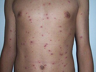Altamente contagiosa, a catapora voltou a chamar a atenção no Espírito Santo após a Prefeitura de Guarapari emitir um alerta sobre o aumento de casos da doença. Desde a segunda quinzena de maio até a última sexta-feira (7), a Secretaria Municipal de Saúde (Semsa) contabilizou 18 notificações, sendo 16 casos confirmados e dois descartados. O número representa uma alta expressiva, já que, de janeiro a agosto do ano passado, o município havia notificado apenas dois casos não confirmados. Diante desse cenário, a Vigilância Epidemiológica tem realizado monitoramento e investigação dos registros, além de orientar as equipes de saúde sobre as medidas de prevenção e controle. “É importante que a população fique atenta aos sintomas e procure uma unidade de saúde assim que houver suspeita” Em Vila Velha, foram notificados 17 casos no período entre janeiro e sexta-feira (7), dos quais 10 foram confirmados, segundo a Secretaria Municipal de Saúde. A infectologista da Secretaria de Saúde de Vila Velha, Mylene Murad, afirma que o cenário não é considerado alarmante, mas reforça que a população deve permanecer atenta aos sinais da doença. “Os principais sintomas são febre, mal-estar e as manchinhas espalhadas pelo corpo. É preciso ter cuidado principalmente ao coçar, para não causar infecções ainda mais sérias.” Na Serra, a Secretaria de Saúde informou que, entre janeiro e julho deste ano, foram confirmados 21 casos de catapora. A referência técnica em agravos da Secretaria de Saúde do município, Maria Isabel Delmaestro, diz que o número está dentro do esperado para o período, mas reforça a importância da vacinação. “No Sistema Único de Saúde, a vacina está amplamente disponível. A primeira dose é feita aos 15 meses e a segunda aos quatro anos. Ela reduz muito a chance de evoluir para casos graves.” Em Vitória, foram confirmados 21 casos de catapora entre janeiro e julho deste ano, segundo a Secretaria Municipal de Saúde. A vacina contra a doença está disponível em todas as unidades de saúde do município. Já em Cariacica, até sexta-feira (7), foram notificados 14 casos de catapora neste ano, dos quais 12 foram confirmados, de acordo com a Secretaria Municipal de Saúde. O que é a catapora e como ocorre a transmissão Também conhecida como varicela, a catapora é uma doença infecciosa causada por vírus e altamente contagiosa. A transmissão ocorre pelo ar, por meio de fala, tosse e espirros, e também pelo contato direto com o líquido das lesões ou com objetos contaminados. A pessoa pode transmitir a doença antes mesmo do aparecimento das lesões e continua contagiosa enquanto houver lesões ativas na pele. Sintomas mais comuns da doença Entre os principais sinais e sintomas da catapora estão: Febre Mal-estar Dor de cabeça Manchas vermelhas pelo corpo Bolhas na pele Formação de crostas Coceira intensa Cuidados e quando procurar atendimento Alguns cuidados são essenciais para evitar complicações e novas transmissões: Evitar coçar as lesões, pois elas podem ser contaminadas e provocar infecções secundárias. Pessoas com suspeita ou confirmação da doença devem evitar contato com outras pessoas. Retornar às atividades apenas quando todas as lesões estiverem em fase de crosta. Ao apresentar sintomas, procurar uma unidade de saúde para avaliação. Vacinação contra a catapora pelo SUS A vacina é a principal forma de prevenção contra a catapora. No Sistema Único de Saúde (SUS), a primeira dose é aplicada aos 15 meses de idade, e a segunda dose é aplicada aos quatro anos. Nos municípios citados, a imunização está disponível nas unidades de saúde, e as prefeituras reforçam a importância de manter o calendário de vacinação em dia para reduzir o risco de casos graves. Números de casos de catapora no ES Confira a situação informada pelas prefeituras e secretarias de Saúde: Guarapari: 18 notificações desde a segunda quinzena de maio até 7 de agosto, sendo 16 casos confirmados. Vitória: 21 casos confirmados entre janeiro e julho; no mesmo período de 2025, foram 26 casos. Vila Velha: 17 notificações entre 1º de janeiro e 7 de agosto, sendo 10 casos confirmados. Serra: 21 casos confirmados entre janeiro e julho. Cariacica: 14 notificações até 7 de agosto, com 12 casos confirmados. Veja mais em: https://tribunaonline.com.br/saude/casos-de-catapora-crescem-no-es-e-cidades-emitem-alerta-328222?home=espirito_santo